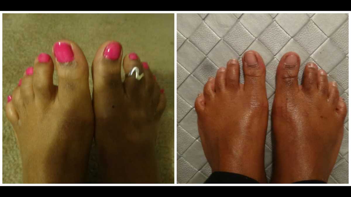 Easy and Safe Ways to Remove Gel Polish from Toes Without a Drill Seek Professional Help if Needed