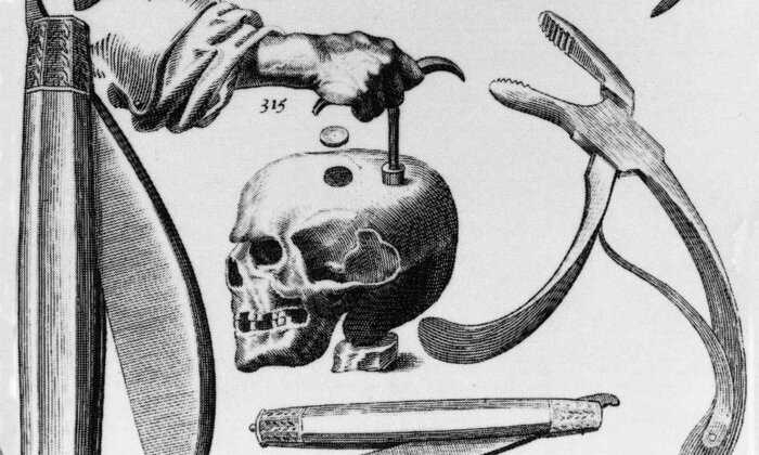 Trepanation: What is it and why do people do it? 3. Personal Transformation and Self-Exploration