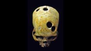 Trepanation: What is it and why do people do it? Reasons for Trepanation