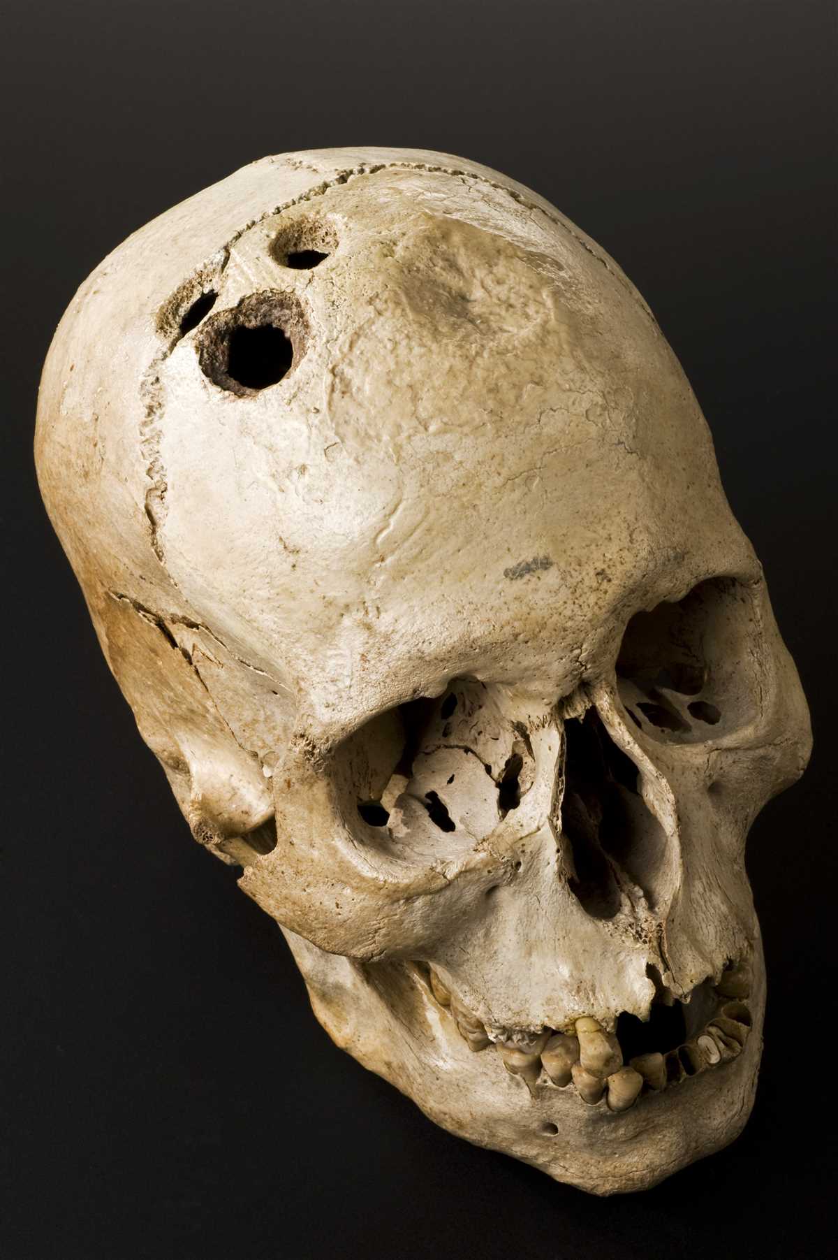 Trepanation: What is it and why do people do it? Medical Beliefs